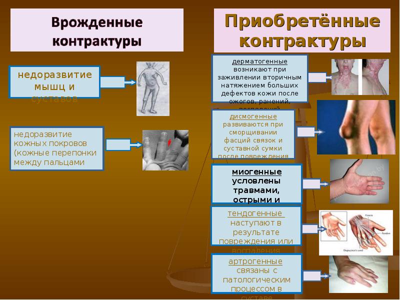 Степени контрактур суставов