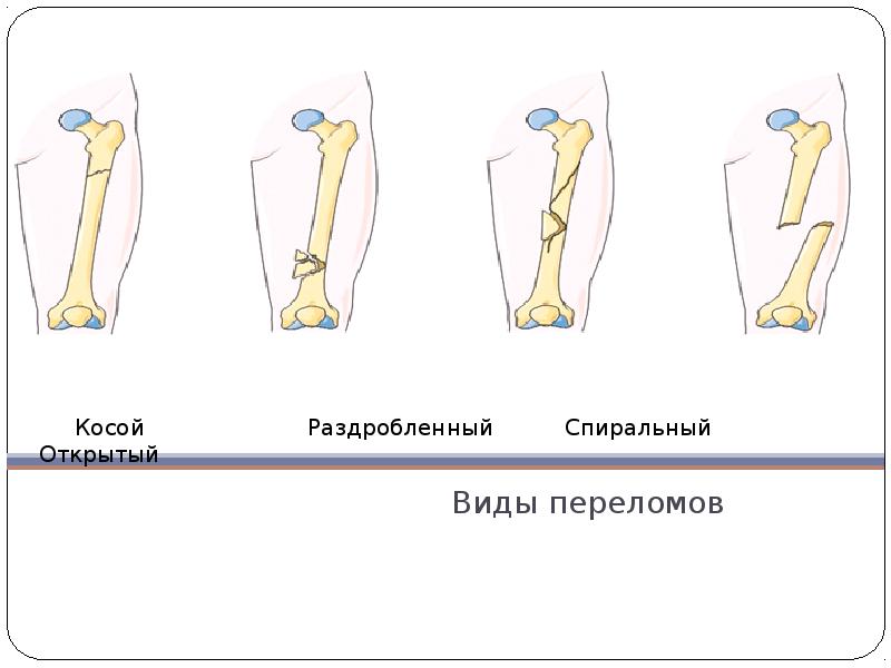 Виды переломов нижних конечностей. Перелом по типу открытой книги. Виды огнестрельных переломов.