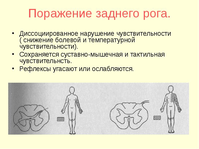 Болевое нарушение чувствительности. Снижение болевой и температурной чувствительности. Диссоциированный Тип расстройства чувствительности. Синдромы поражения чувствительности. Синдром диссоциированного нарушения чувствительности.