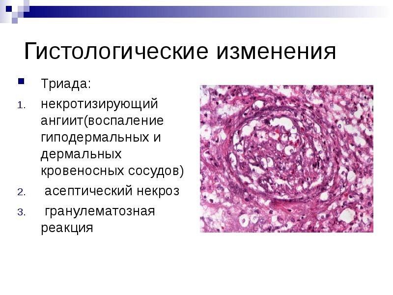 Хроническое гранулематозное воспаление