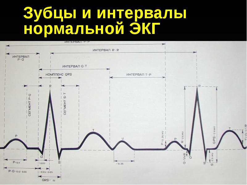 Интервалы экг. ЭКГ зубцы и интервалы. Норма r-r интервалов ЭКГ. Интервал PQ В норме ЭКГ 25 мм. Интервал RR на ЭКГ норма.