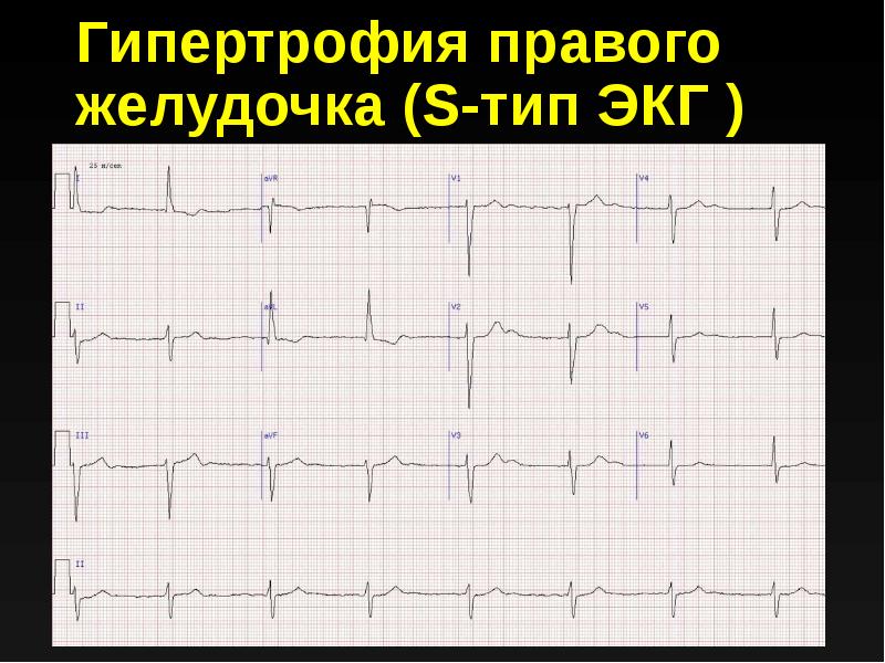 Перегрузка левого желудочка