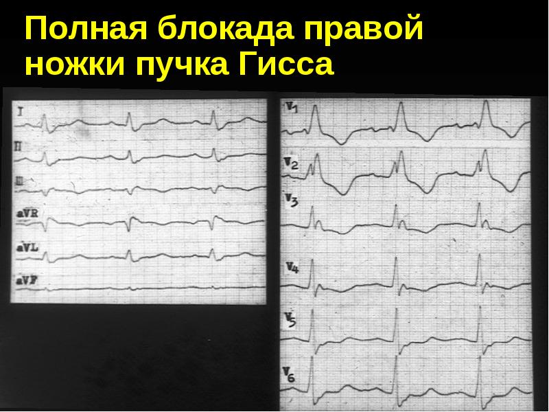 Блокада правой ножки. Полная блокада правой ножки Вильсона. Переходящая блокада правой ножки пучка. Признаком полной блокады правой ножки является. Полная блокада правой руки.