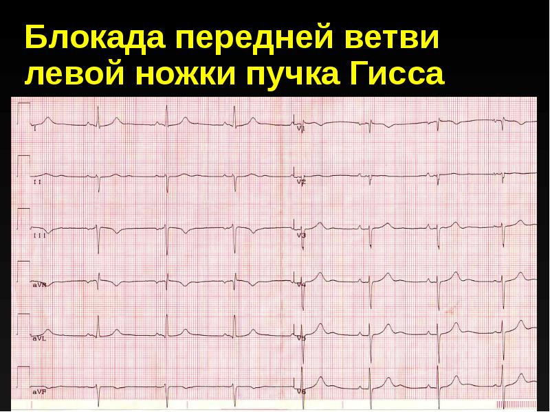 Блокада передней левой ножки. Передне верхний полублок на ЭКГ. ЭКГ блокада передней ветви. Блокада передней ветви левой ножки пучка Гиса на ЭКГ. ЭКГ С блокадой передней ветви левой ножки пучка ГИС.