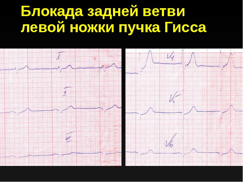 Блокада левой ветви пучка гиса. Блокада задней ветви левой ножки пучка Гиса на ЭКГ. Блокада задне Нижнего разветвления левой ножки пучка Гиса. Блокада задней ветви левой ножки. Блокада задней ветви левой ножки пучка.