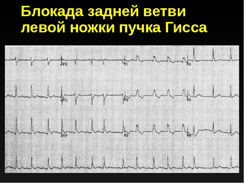 Полная блокада левой ножки карта вызова