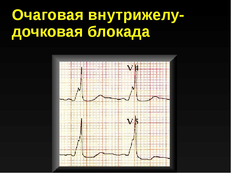 Очаговое нарушение внутрижелудочковой. Локальная внутрижелудочковая блокада на ЭКГ. Неспецифические внутрижелудочковые блокады. Очаговая внутрижелудочковая блокада. Очаговая блокада на ЭКГ.