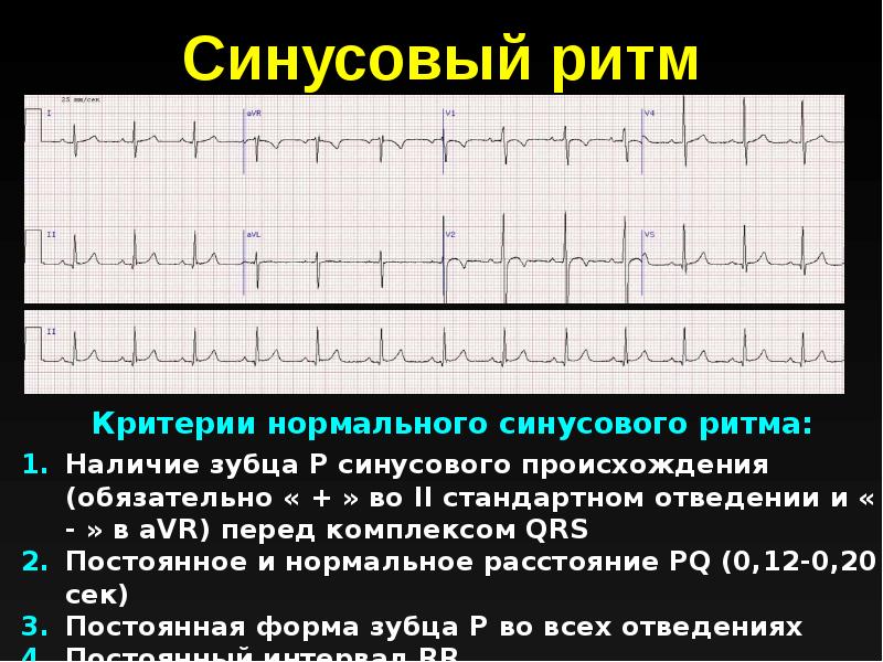 Ритм эос. Ритм синусовый и несинусовый. Ритм синусовый 60 ударов в минуту. Оценка ритма (синусовый и несинусовый, правильный и неправильный). Критерии ритма синусового происхождения.