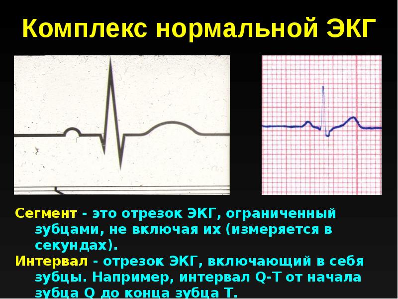 Сегменты экг. Нормальный комплекс ЭКГ. Наводка на ЭКГ. Презентация на тему ЭКГ.