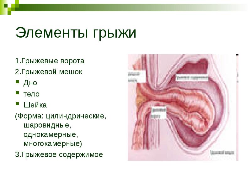 Грыжевые ворота