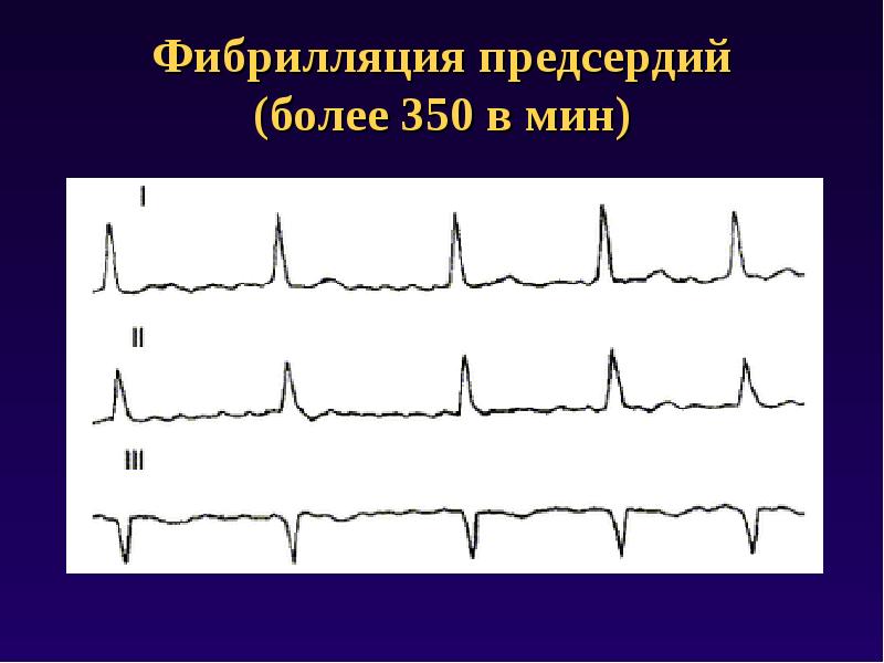Нарушение проводимости предсердий