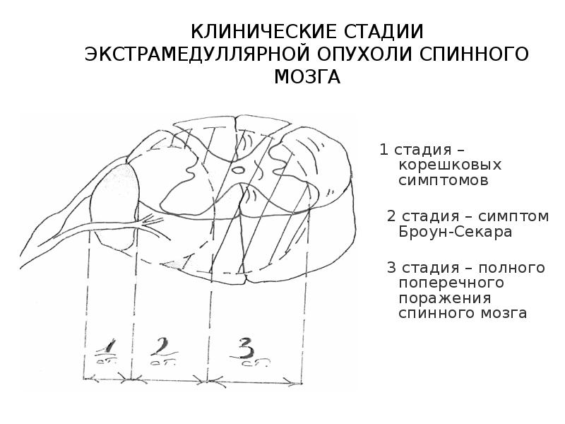 Опухоли головного и спинного мозга презентация