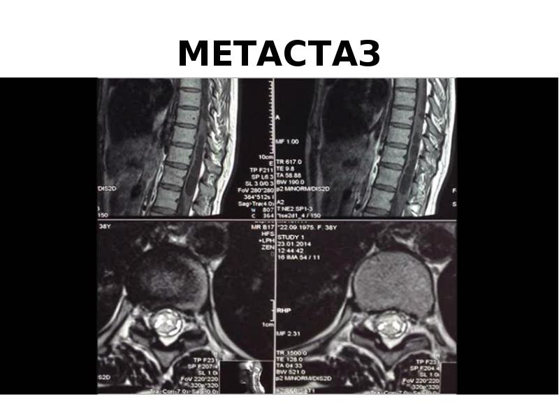 Метастазы в мозг форум