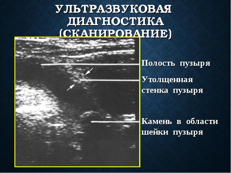 Утолщение стенок тонкого кишечника на узи