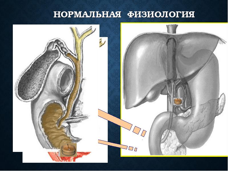 Острый холецистит презентация