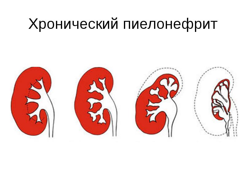 Хронический пиелонефрит картинки