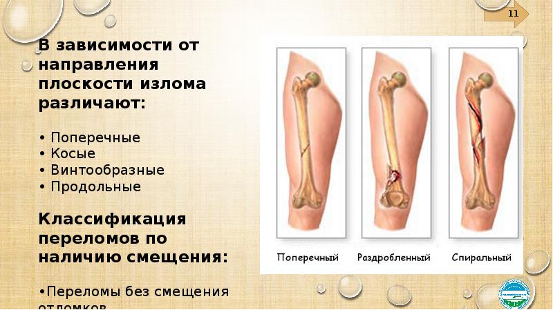 Переломы и вывихи общая хирургия презентация