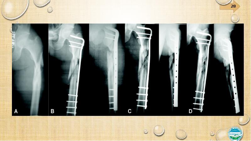 Переломы и вывихи общая хирургия презентация
