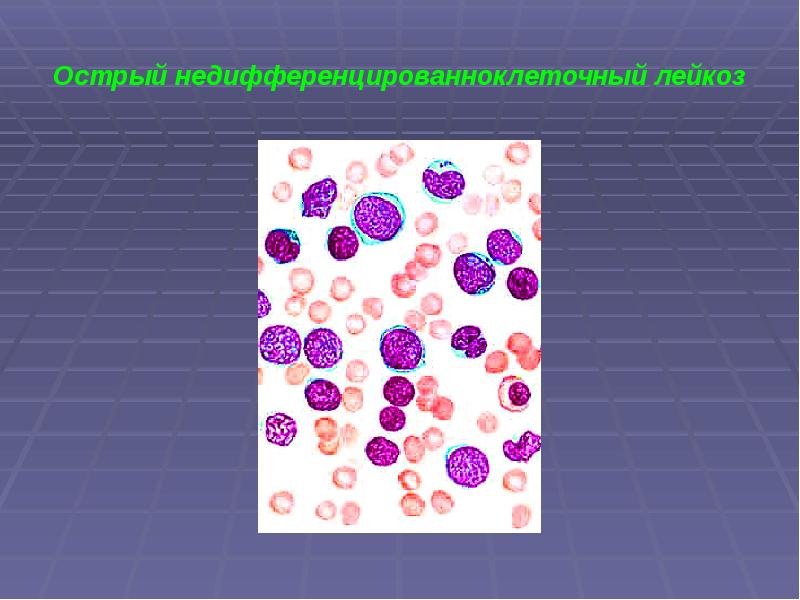 Лейкозы картинки для презентации