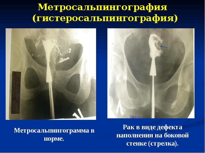 Методика гистеросальпингографии рисунок