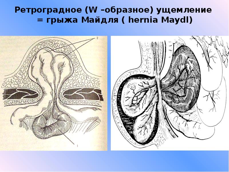 Ущемленная грыжа презентация