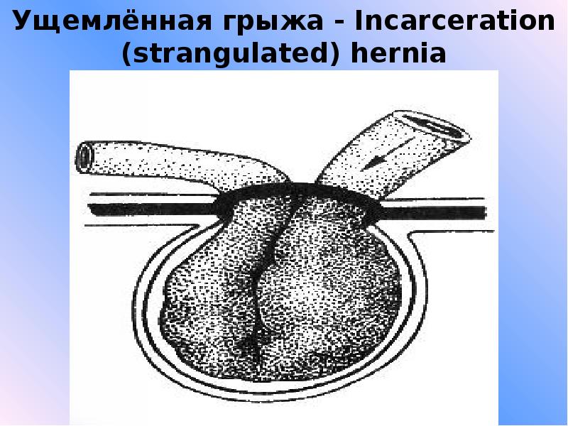 Ущемленная грыжа белой линии живота карта вызова