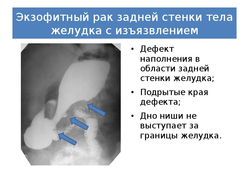 дефект наполнения желудка