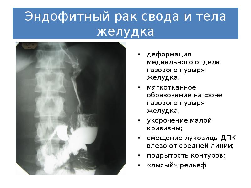 Признаки роста опухоли. Эндофитная опухоль желудка. Опухоль желудка на рентгене признаки. Эндофитная опухоль желудка рентген. Эндофитного объемного образования желудка.