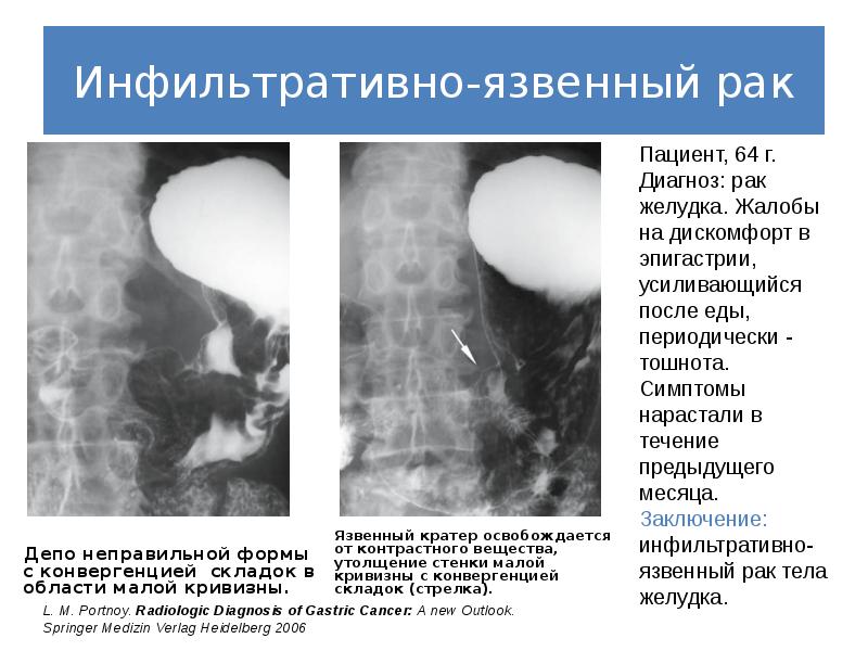 Рак желудка презентация по онкологии