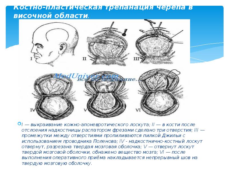 Костно-пластическая трепанация черепа в височной области.  I — выкраивание кожно-апоневротического