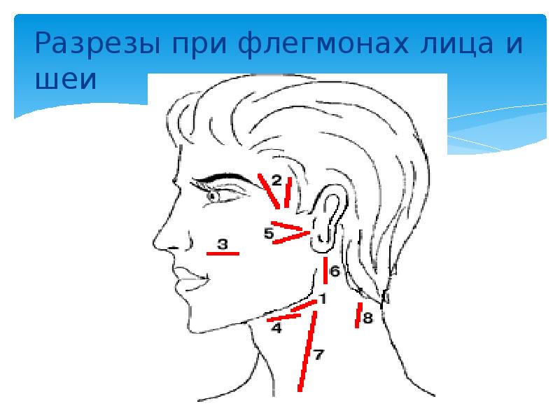 Разрезы при флегмонах лица и шеи