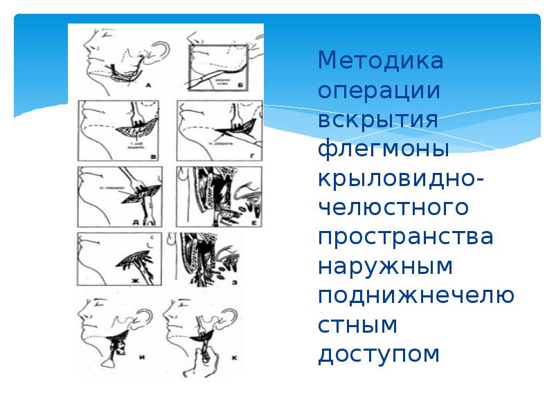 Методика операции вскрытия флегмоны крыловидно-челюстного пространства наружным поднижнечелюстным доступом