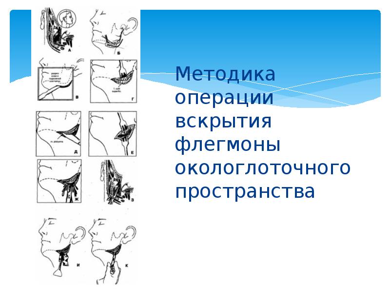 Методика операции вскрытия флегмоны окологлоточного пространства