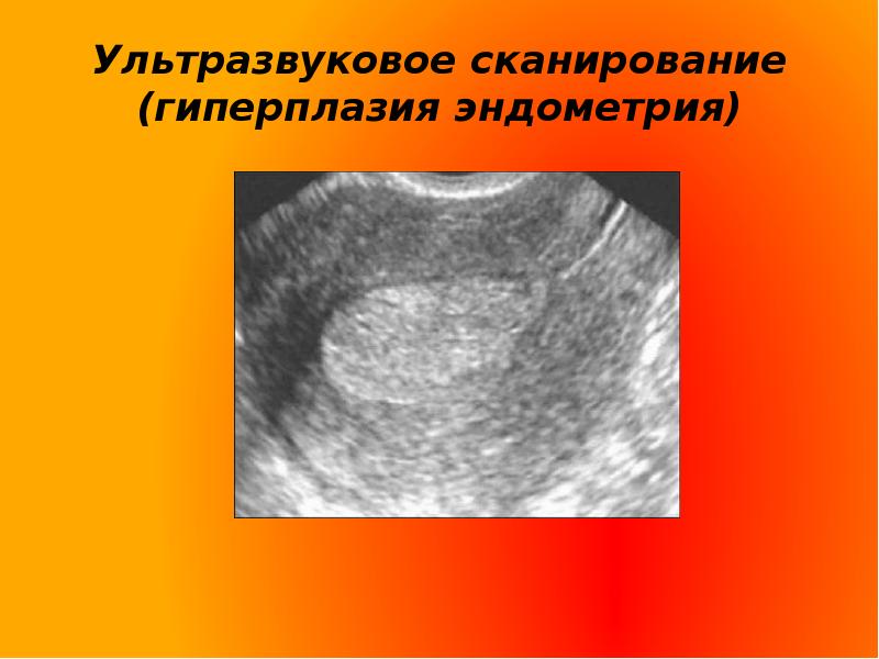 Железистая гиперплазия эндометрия после