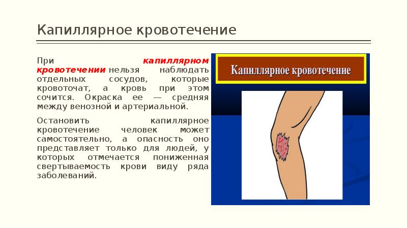 Виды кровотечений презентация обж