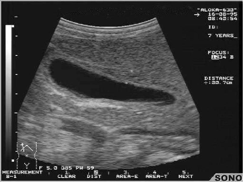 Атлас УЗИ * Желчный пузырь, B-режим, эхограмма № 500