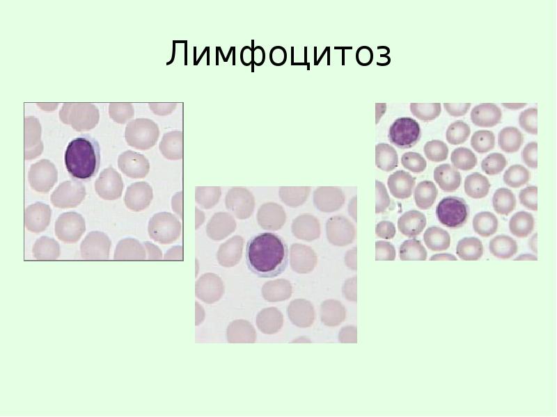 Лимфоцитоз. Лимфоцитоз картина крови. Лимфоцитоз мазок крови. Лимфоцитоз патогенез. Лимфоцитоз 2.46.