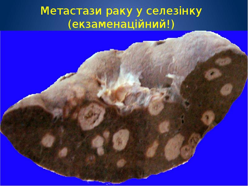 Метастазы в желудке прогноз. Метастазы в желудке прогноз