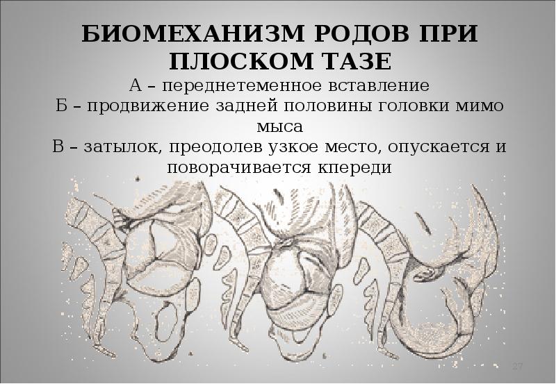 Биомеханизм родов. Биомеханизм родов при плоском тазе. Биомеханизм родов при таз. Роды при плоском тазе.