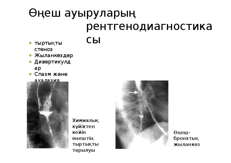 Өңеш обыры презентация