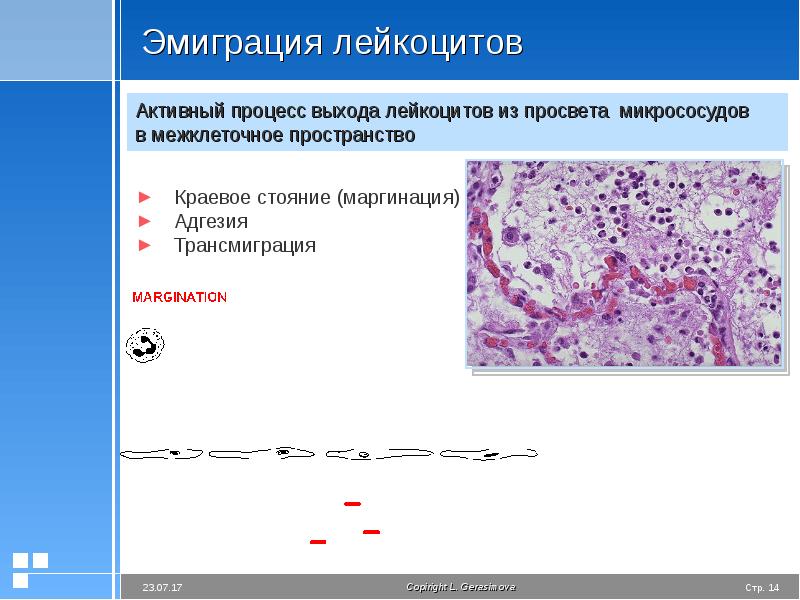 Пролиферация призматического эпителия на фоне воспаления