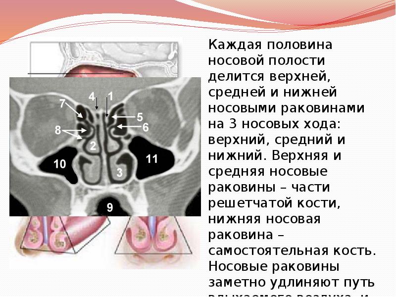 Соустье гайморовой пазухи