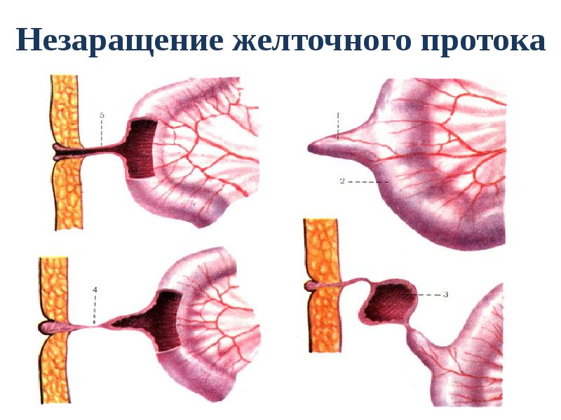 Брюшной тиф патологическая анатомия презентация