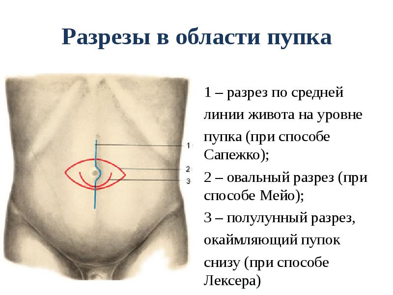 Топография брюшной стенки презентация