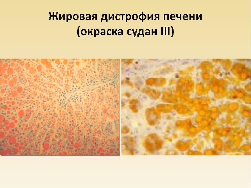 Паренхиматозная жировая дистрофия фото