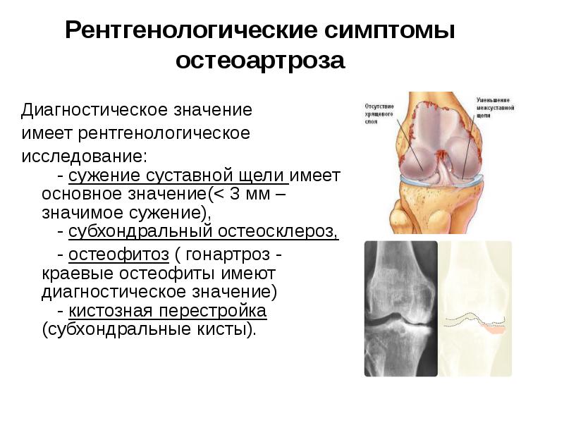 Лечение остеоартроза презентация