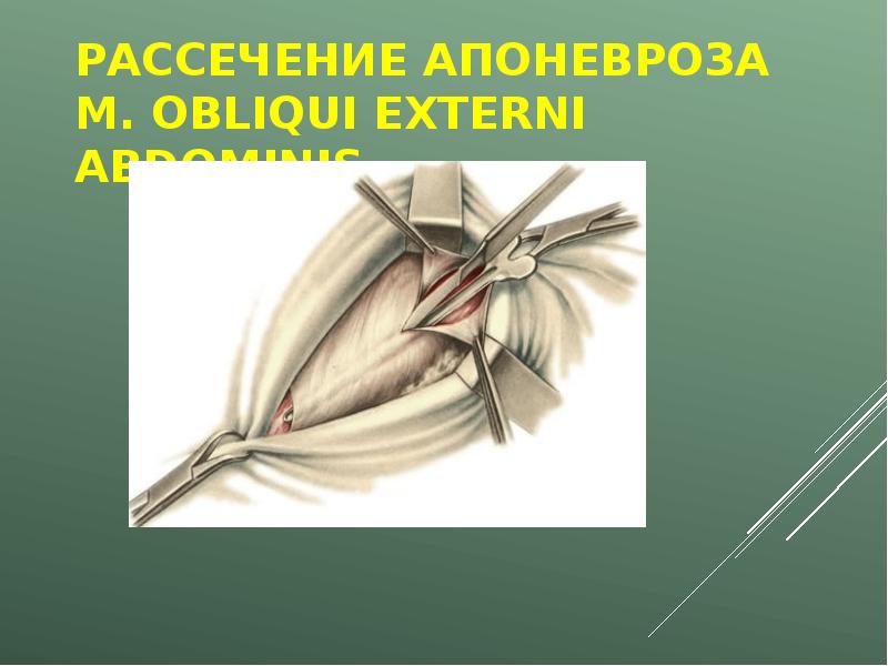 Какую стенку бедренного кольца рассекают при ущемленной бедренной грыже