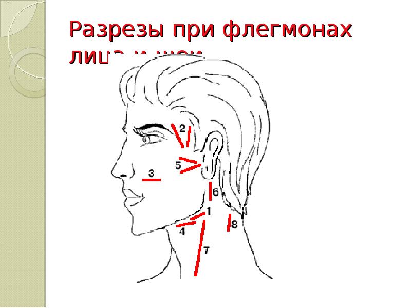 Разрезы при флегмонах лица и шеи