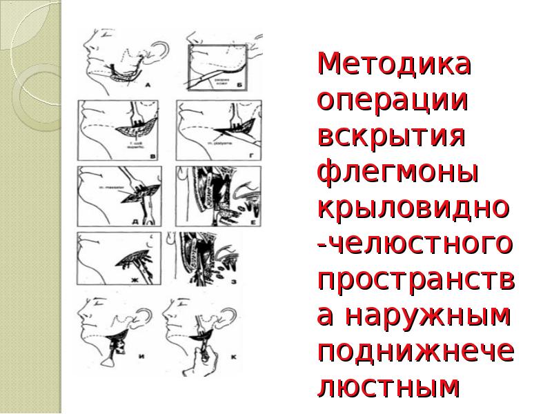 Методика операции вскрытия флегмоны крыловидно-челюстного пространства наружным поднижнечелюстным доступом
