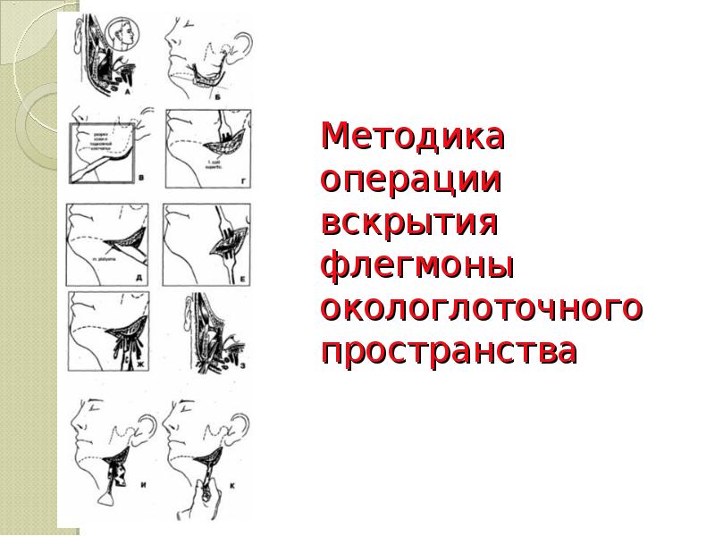 Методика операции вскрытия флегмоны окологлоточного пространства